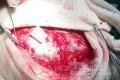 Acute Spontaneous Subdural Hemorrhage in the Subdural Space