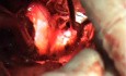 Fishbone in the oesophagus 