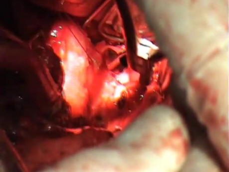 Fishbone in the oesophagus 