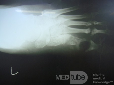 Diabetic foot ulcer - neuropathic -associated with ostemyelitis 