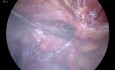 Inguino Scrotal Hernia Laparoscopic Surgery