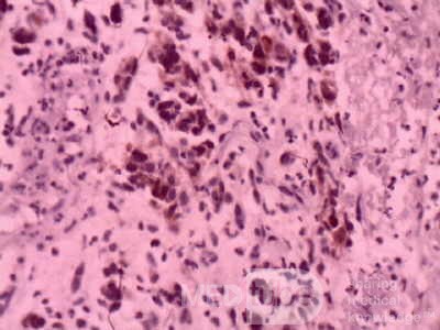 Gastrointestinal Stromal Tumour of the Rectum (5 of 5)