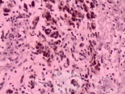 Gastrointestinal Stromal Tumour of the Rectum (5 of 5)