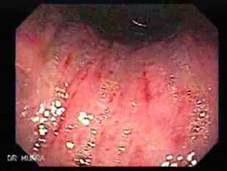 Peptic Ulcer And Liver Cirrhosis (2 of 5)