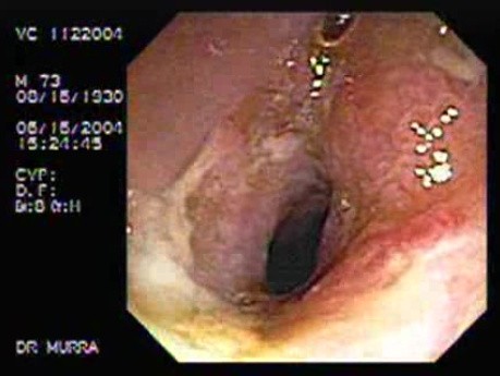 Crohn´s Disease of the Ileocecal Valve and Terminal Ileum (3 of 5)