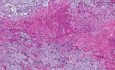 Pleomorphic adenoma - Histopathology of salivary gland