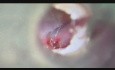 Glue Ear Miringotomy - Miringotomía Por Glue Ear