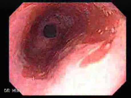 Barrett's Esophagus of long segment - Barrett's tongue (4 of 24)