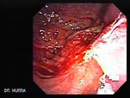 Gastric Cicatrization With Pylorus Stenosis (16 of 23)
