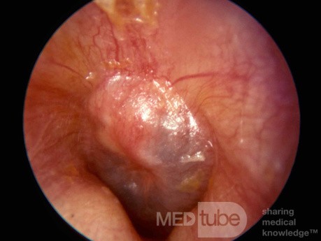 Early Acute Otitis Media