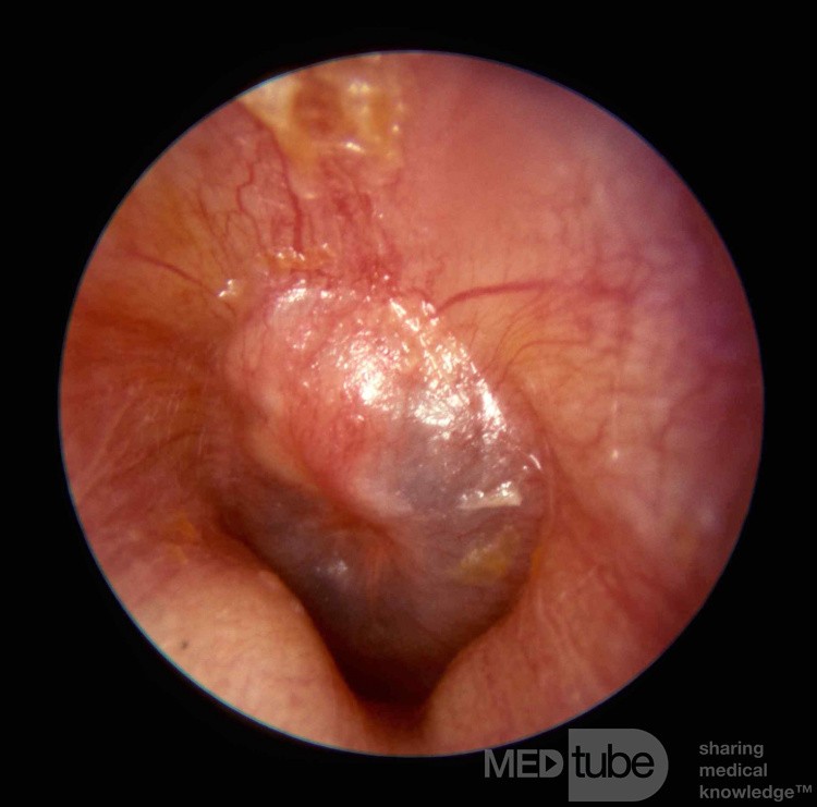 Early Acute Otitis Media