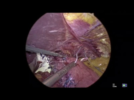 Geometry Fundoplication App Tutorial, Chapter 09 - Creating The 360º Fundoplication
