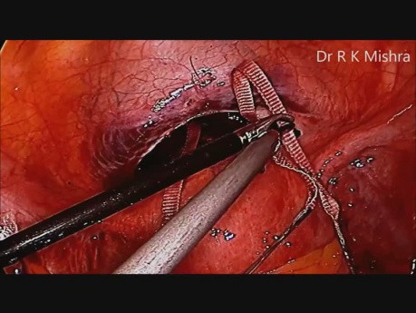Laparoscopic Cervical Cerclage for Cervical Incompetence or Insufficiency