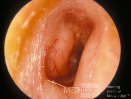 Cerumenoma