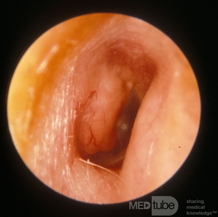 Cerumenoma