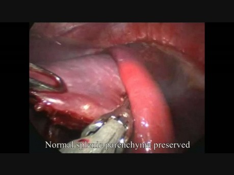 Laparoscopic Splenic Cyst Surgery