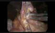 Minimally İnvasiv İvor Lewis Esophagectomy