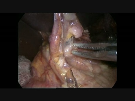 Minimally İnvasiv İvor Lewis Esophagectomy