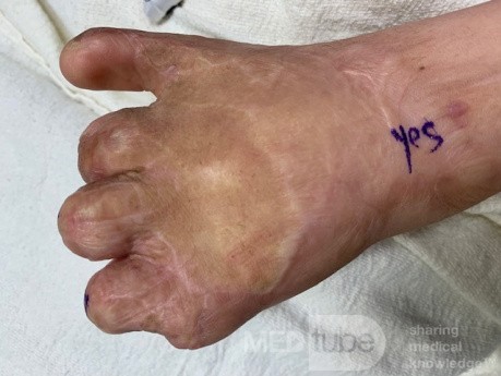 Burned Hand Reconstruction on Syrian Girl