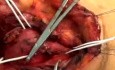 Carotid Body tumor