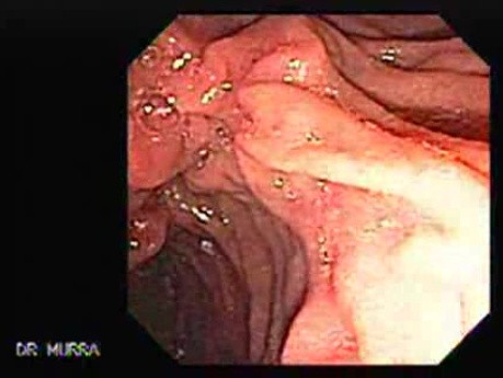 Cholangiocarcinoma (4 of 4)