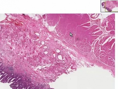 Barrett esophagus - Histopathology - Esophagus