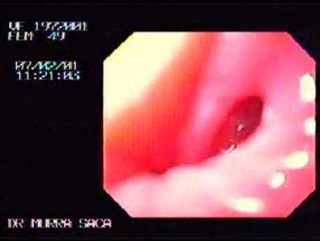 Esophageal Achalasia (2 of 7)
