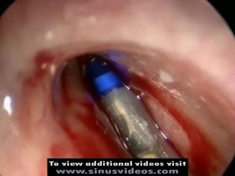 Frontal Balloon Sinuplasty