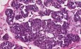 Lobular carcinoma in situ - Histopathology - Breast