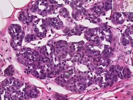 Lobular carcinoma in situ - Histopathology - Breast