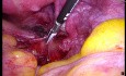 Deep Endometriosis