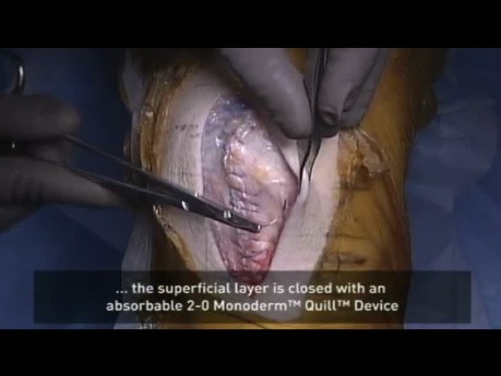 Tissue Closure of a Knee Arthoplasty by Dr Della Valle
