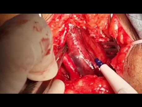 How to Perform Lower Extension AVF with Goretex in Patient with Previous SVCS and TV endocarditis
