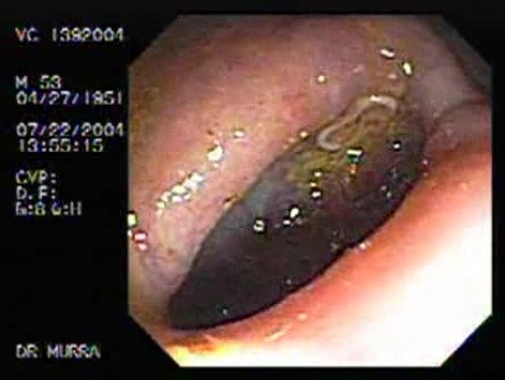 Trichuris Trichiura (whipworm) (3 of 5)