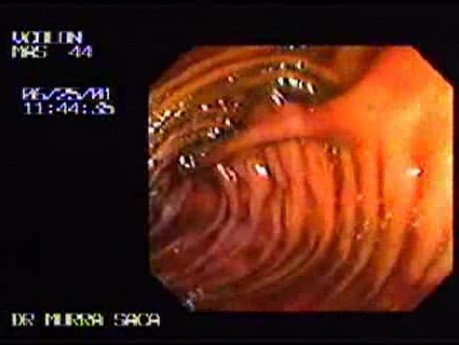 Anastomosis Recto-Jejunum