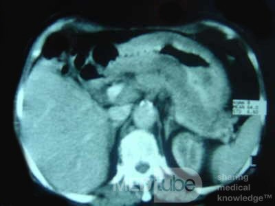 ScirrhousGastric Carcinoma (Linitis Plastica) (11 of 15)