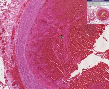 Lung - Thromboembolus (Thromboembolism)