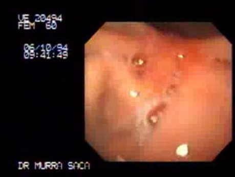 Ulcer Scars (1 of 2)