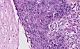 Squamous cell carcinoma - Histopathology - Esophagus