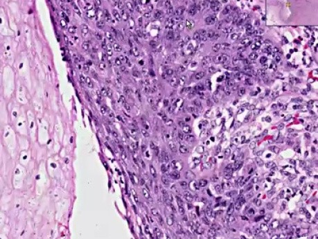 Squamous cell carcinoma - Histopathology - Esophagus