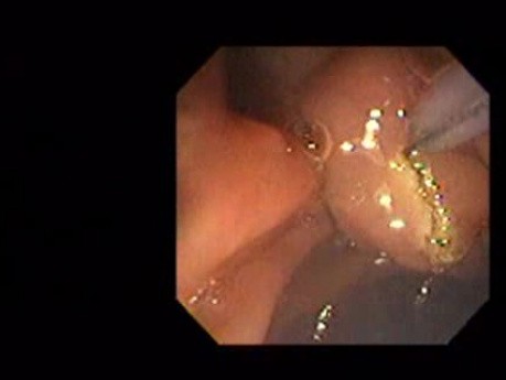 Adenocarcinoma of the Pancreas (6 of 8)