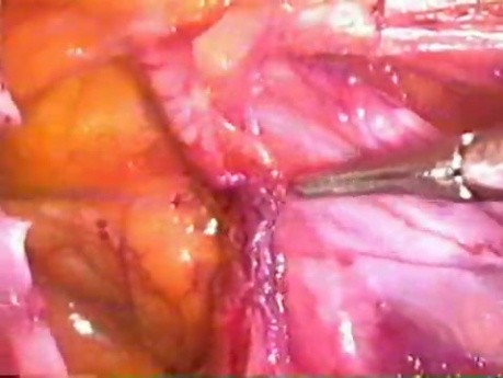 Inguinal hernia repair - TAPP method