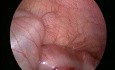 Laparoscopic Reduction of Intussusception in Infant 2