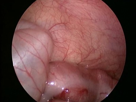Laparoscopic Reduction of Intussusception in Infant 2