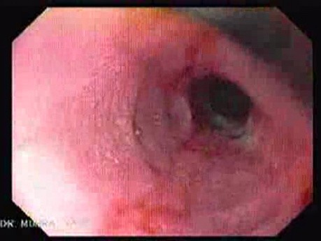Reflux Esophagitis - Esophagoscopy