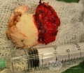 Epicranial Tumor Injury