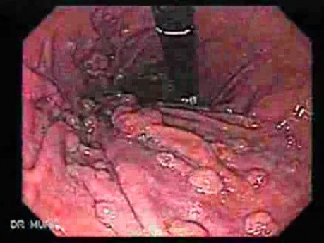 Hyperplastic Gastric Polyposis - Endoscopy (2 of 6)
