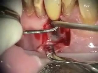 Reparation After An Atypical infection