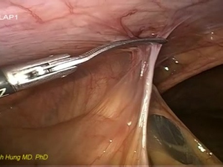 Laparoscopic Revisional Hepaticojejunostomy for Anastomotic Structure
