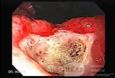 Two Ulcers in a Cirrhotic Patient - Retroflexed View